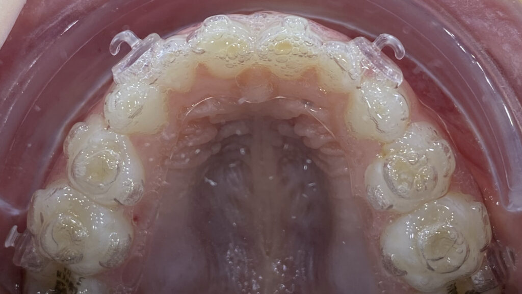 alineadores en boca de un paciente