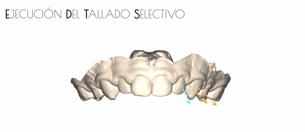 modelo 3d de la mandibula superior